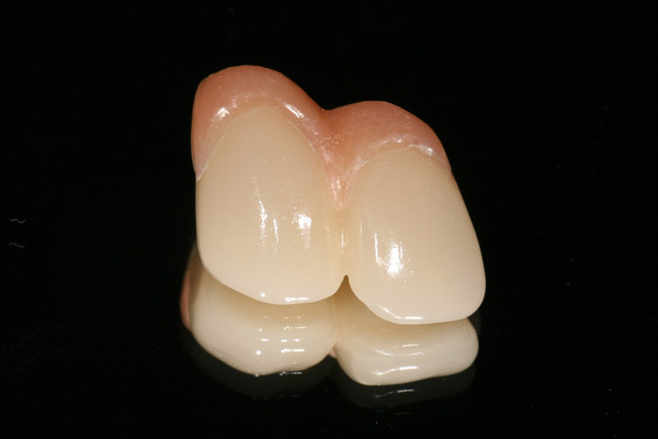 그림 50. 전치부 임플란트 크라운의 경우, 치관의 길이가 길어 핑크 포세린을 사용해 치은을 형성했다