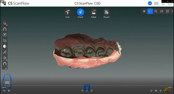 CS 리스토어를 사용하면 치과의사는 단 한 번의 클릭으로 교합면을 정확하게 정의할 수 있으며 컴퓨터 사양에 따라 30초~1분 안으로 최종 디자인 보철물을 만들 수 있다