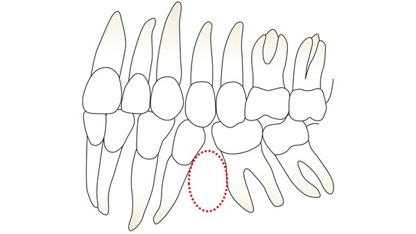[사진2] 치아가 결손되어 주위 치아들이 쓰러져 있다.