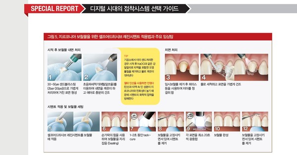 지르코니아 보철물을 위한 셀프어드히시브 레진시멘트 적용법(출처: Clinical Guidelines & Tips:한국접착치의학회, 한국3M)