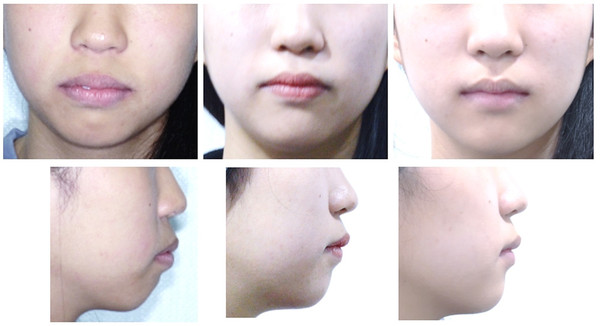 Figure.15 Comparison of Facial Photo between Initial, Just After Early Debonding & Just After Aligner Treatment (Dec. 5, 2020), Upper-Frontal Facial Photo, Lower-Profile Photo