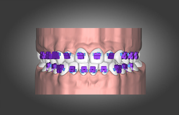 AUTOLIGN은 알고리즘 기반으로 사용자가 치아를 이동시키지 않고 자동으로 모든 치아를 정렬시킬 수 있는 기능이다